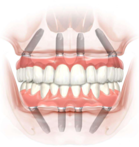 Soluzioni implantologiche quando manca osso per rifare tutti i denti