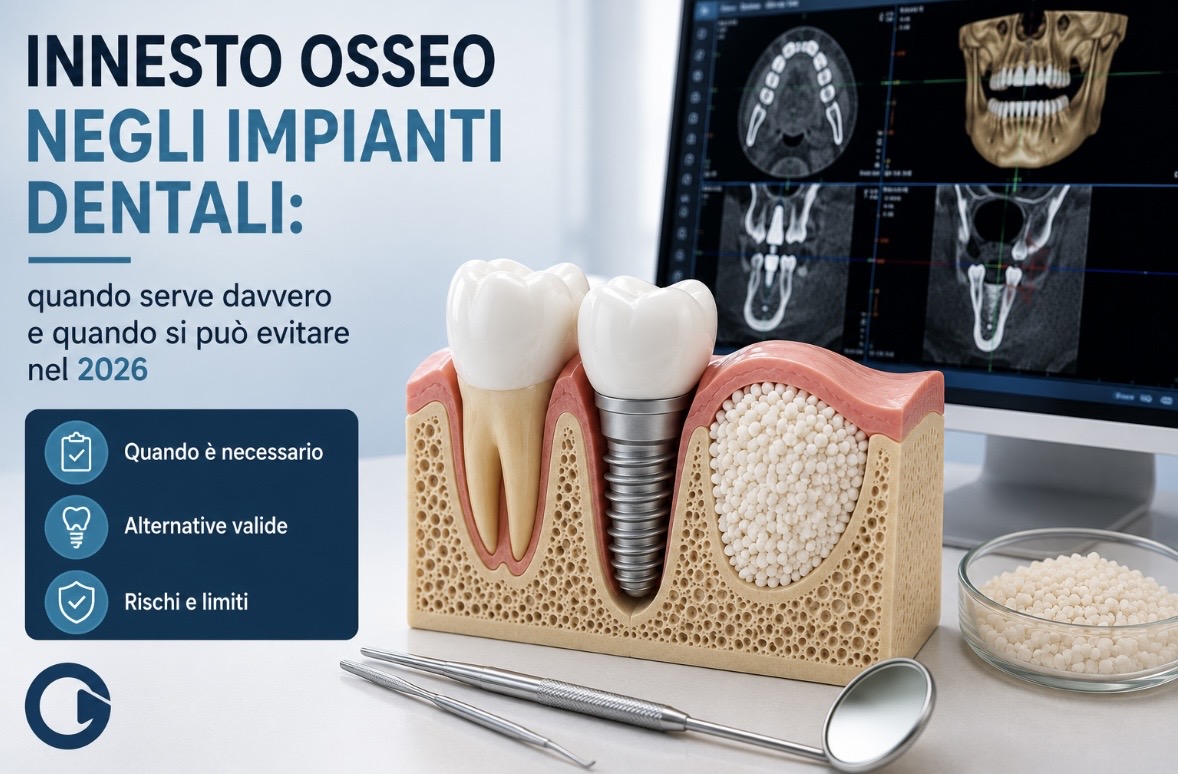 Innesto osseo negli impianti dentali: quando può essere necessario